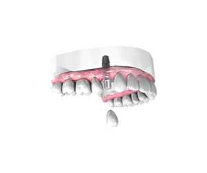 Pose d une couronne dentaire sur implant Bordeaux