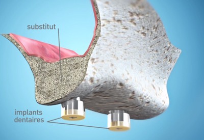 Sinus-Lift-4-Dentiste Bordeaux