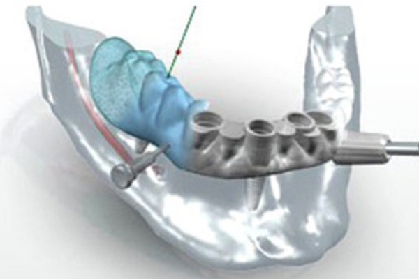 chirurgie-guidee-par-ordinateur - Dentiste Bordeaux