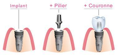 implant-dentaire-dentiste-bordeaux_0