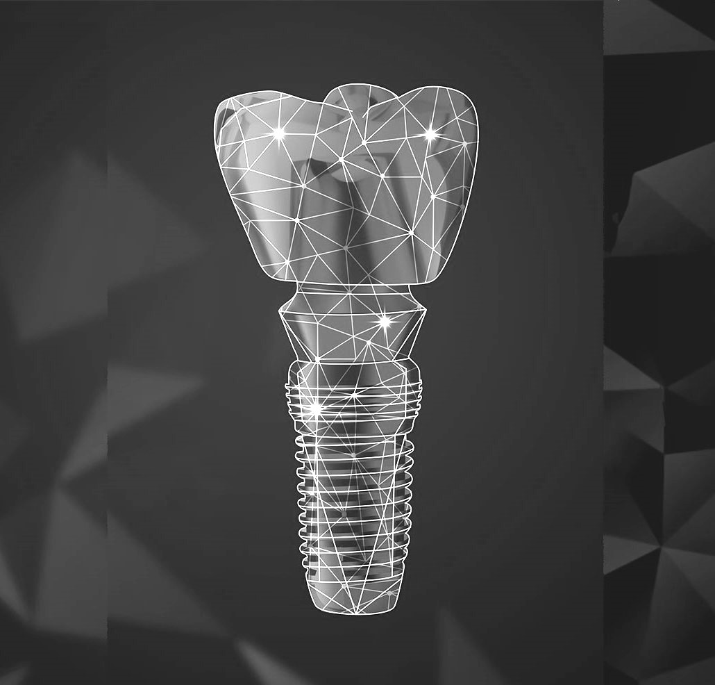 implants-dentaires-dentiste-bordeaux